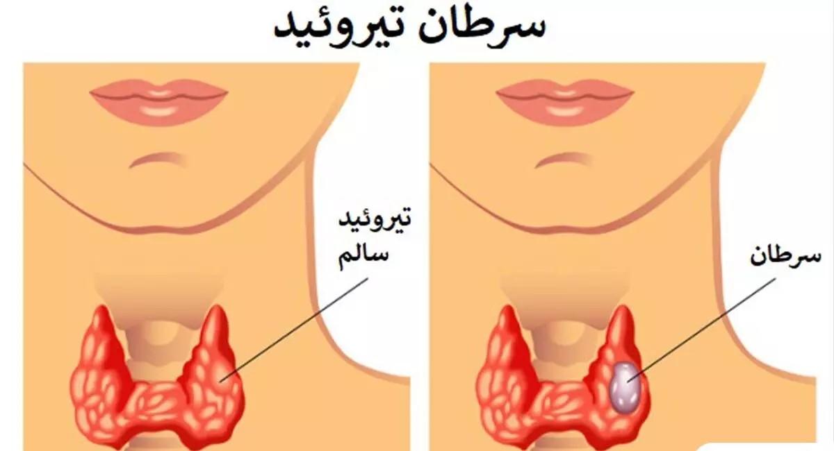 نکات مهم درباره سرطان تیروئید | علائم گمراه کننده سرطان تیروئید